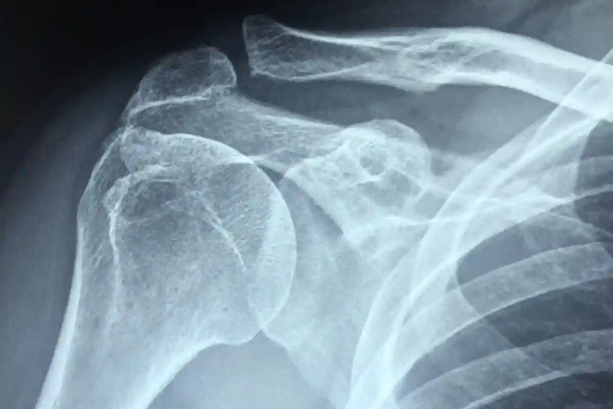 Імператорський синдром плечового суглоба: чому біль і нерухомість трапляються в плечі. Фото: taokinesis / pixabay.com