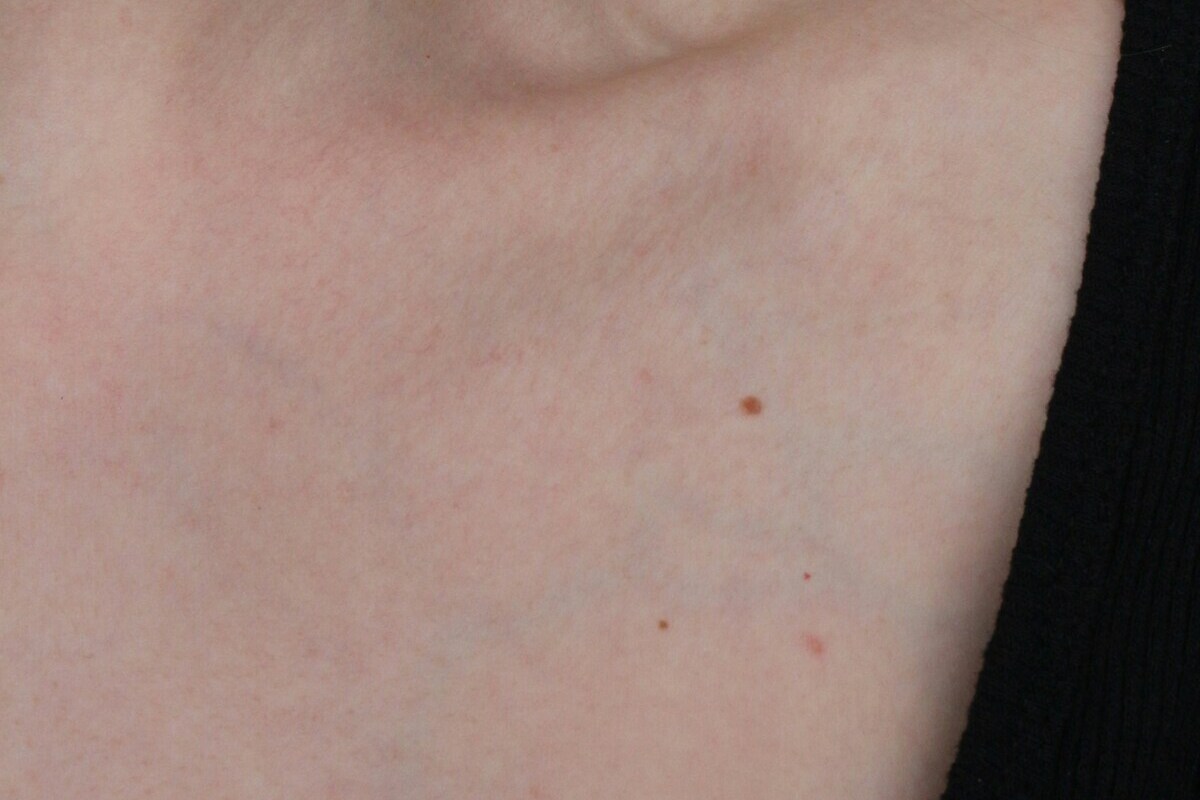 Скринінг на рак шкіри: коли пора звернутися до дерматолога в Німеччині. Фото: Марія Іоффе / unsplash.com